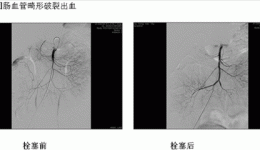 消化科血管介入止血