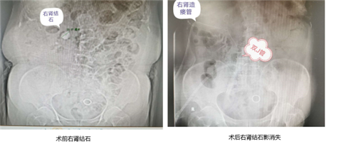 精准PCNL为众多基础疾病老奶奶顺利处理折磨多年的肾结石(1)(1)1196.png