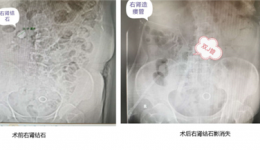 泌尿外科精準PCNL術(shù)為多病纏身老人取出折磨多年的腎結(jié)石