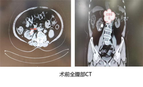 精準PCNL為眾多基礎疾病老奶奶順利處理折磨多年的腎結石(1)(1)758.png