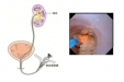 泌尿外科丨输尿管软镜碎石取石术
