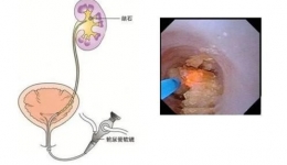 泌尿外科丨输尿管软镜碎石取石术