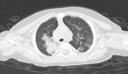 嬰幼兒感染RSV竟致呼吸衰竭！專家提醒：這種“沉默威脅”正襲擾幼兒