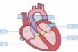 TAVR--经皮主动脉瓣置换术