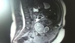 动脉球囊阻断术辅助前置胎盘手术